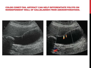 ultrasound-artifacts-and-contrast-enhanced-ultrasound-pptx