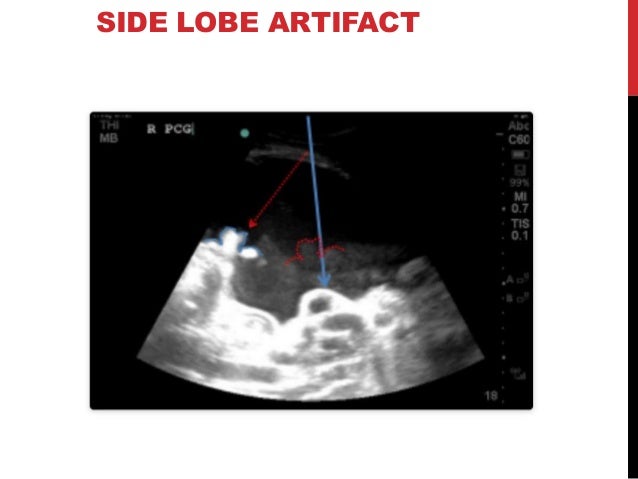Ultrasound artifacts and contrast enhanced ultrasound