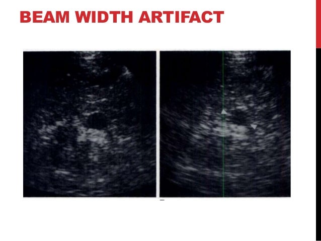 Ultrasound artifacts and contrast enhanced ultrasound