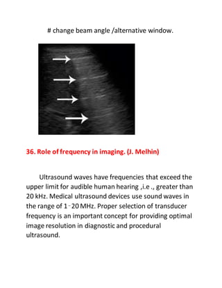 # change beam angle /alternative window.
36. Role of frequency in imaging. (J. Melhin)
Ultrasound waves have frequencies that exceed the
upper limit for audible human hearing ,i.e ., greater than
20 kHz. Medical ultrasound devices use sound waves in
the range of 1–20 MHz. Proper selection of transducer
frequency is an important concept for providing optimal
image resolution in diagnostic and procedural
ultrasound.
 