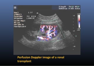 Perfusion Doppler image of a renal
transplant
 