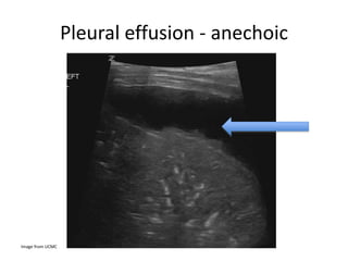 Pleural effusion - anechoic
Image from UCMC
 