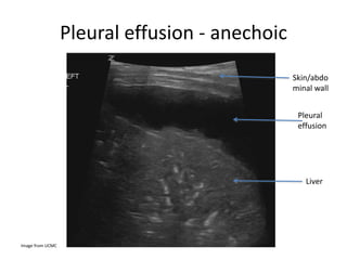 Pleural effusion - anechoic
Image from UCMC
Pleural
effusion
Liver
Skin/abdo
minal wall
 