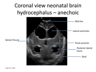 Coronal view neonatal brain
hydrocephalus – anechoic
Image from UCMC
Mid-line
Lateral ventricles
Third ventricle
Posterior lateral
horns
Skull
Sylvian fissure
 