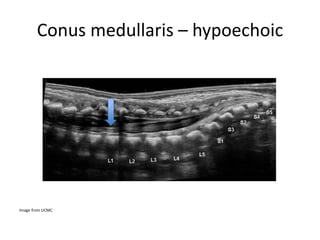 Conus medullaris – hypoechoic
Image from UCMC
 