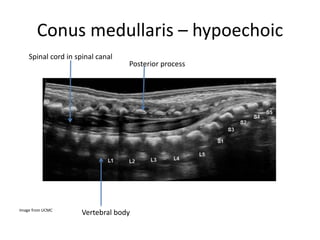 Conus medullaris – hypoechoic
Image from UCMC
Vertebral body
Spinal cord in spinal canal
Posterior process
 