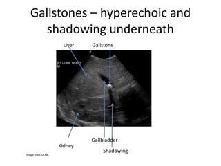 Gallstones – hyperechoic and
shadowing underneath
Image from UCMC
Kidney
Gallstone
Gallbladder
Shadowing
Liver
 