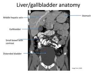 Liver/gallbladder anatomy
Middle hepatic vein
Gallbladder
Small bowel with
contrast
Distended bladder
Stomach
Image from UCMC
 