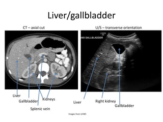 Liver/gallbladder
Liver
CT – axial cut
Kidneys
Gallbladder
U/S – transverse orientation
Liver Right kidney
Gallbladder
Splenic vein
Images from UCMC
 