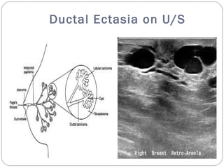 Ultrasound breast mass Slide 23