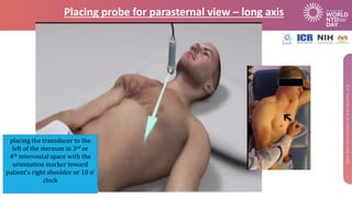Placing probe for parasternal view – long axis
placing the transducer to the
left of the sternum in 3rd or
4th intercostal...