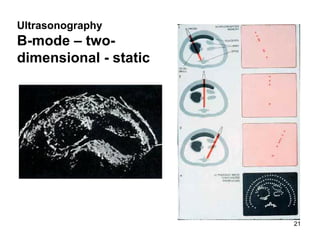 Ultrasonography   B- mode  – two-dimensional  - static 