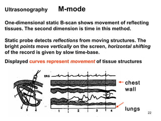 Ultrasonography  M-mode  One-dimensional static B-scan show s  movement of reflecting tissues. The second dimension is time in this method. Static probe detects  reflections  from moving structures. The bright  points  move  vertically  on the screen,  horizontal shifting  of the record is given by slow time-base. Displayed  curves represent  movement  of tissue structures chest wall lungs 