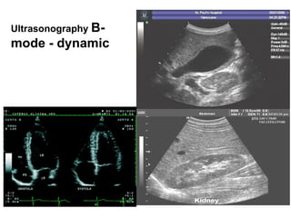 Ultrasonography   B-mode - dynamic 