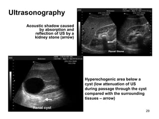 Acoustic shadow caused by absorption and reflection of US by a kidney stone  (arrow) Hyperechogenic area below a cyst (low attenuation of US during passage through the cyst compared with the surrounding tissues  – arrow) Ultrasonography 