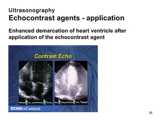 Ultrasonography Echocontrast agents - application Enhanced demarcation of heart ventricle after application of the echocontrast agent 