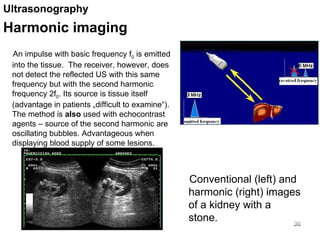 An impulse with basic frequency f 0  is emitted into the tissue.  The receiver, however, does not detect the reflected US with this same frequency but with the second harmonic frequency 2f 0 . Its source is tissue itself (advantage in patients „difficult to examine“). The method is  also  used with echocontrast agents – source of the second harmonic are oscillating bubbles. Advantageous when displaying blood supply of some lesions. Conventional (left) and harmonic (right) images of a kidney with a stone.  Ultrasonography  Harmonic imaging 