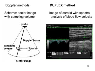 D oppler  methods   DUPLEX method  Scheme :  sector image  Image of carotid with spectral  with sampling volume  analysis of blood flow velocity 