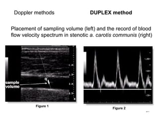 D oppler  methods   DUPLEX method  Placement of sampling volume (left) and the record of blood flow velocity spectrum in  stenotic  a. carotis communis  (right) 