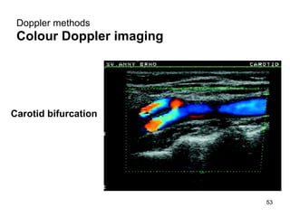 D oppler  methods Colour Doppler imaging   Carotid bifurcation   