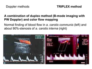 D oppler  methods   TRIPLEX method A combination of duplex method  (B-mode imaging with PW Doppler)  and  color flow mapping   Normal finding of blood flow in  a. carotis communis  (left) and about 90%-stenosis of  a. carotis interna  (right)  