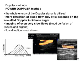 D oppler  methods POWER DOPPLER method the whole energy of the Doppler signal is utilised   mere detection of blood flow only little depends on the  so-called Doppler incidence angle imaging of even very slow flows  (blood perfusion of tissues and organs) flow direction is not shown 