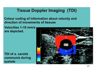 Tissue Doppler Imaging  (TDI) Colour coding of information about velocity and direction of movements of tissues Velocities 1-10   mm/s are depicted. TDI of  a. carotis communis   during systole 