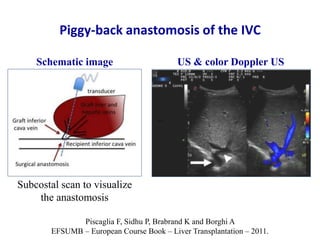Ultrasound & doppler ultrasound in liver transplantation | PPTX