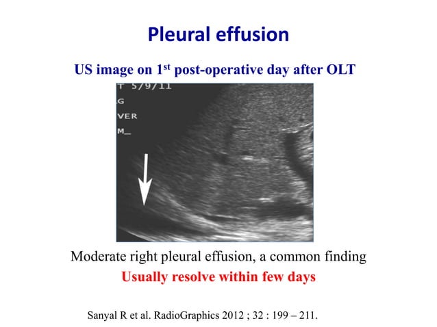 Ultrasound & doppler ultrasound in liver transplantation | PPTX