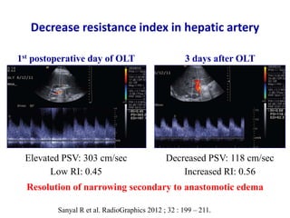 Ultrasound & doppler ultrasound in liver transplantation | PPTX