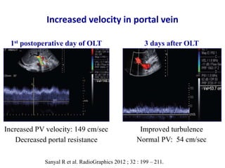Ultrasound & doppler ultrasound in liver transplantation | PPTX