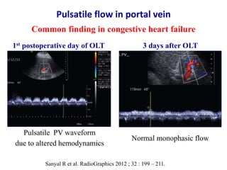 Ultrasound & doppler ultrasound in liver transplantation | PPTX