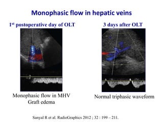 Ultrasound & doppler ultrasound in liver transplantation | PPTX