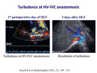 Ultrasound & doppler ultrasound in liver transplantation | PPTX