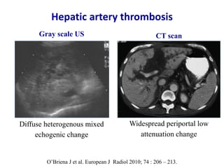 Ultrasound & doppler ultrasound in liver transplantation | PPTX