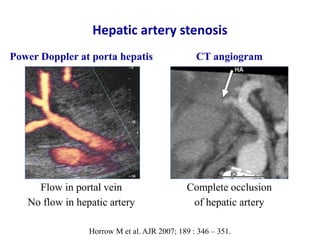Ultrasound & doppler ultrasound in liver transplantation | PPTX