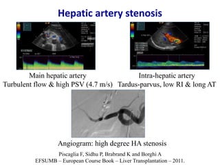 Ultrasound & doppler ultrasound in liver transplantation | PPTX