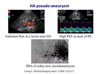 Ultrasound & doppler ultrasound in liver transplantation | PPTX
