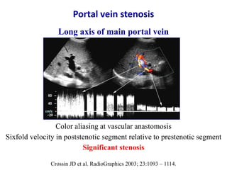 Ultrasound & doppler ultrasound in liver transplantation | PPTX