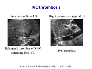 Ultrasound & doppler ultrasound in liver transplantation | PPTX