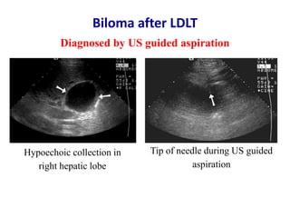 Ultrasound & doppler ultrasound in liver transplantation | PPTX