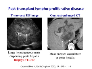 Ultrasound & doppler ultrasound in liver transplantation | PPTX