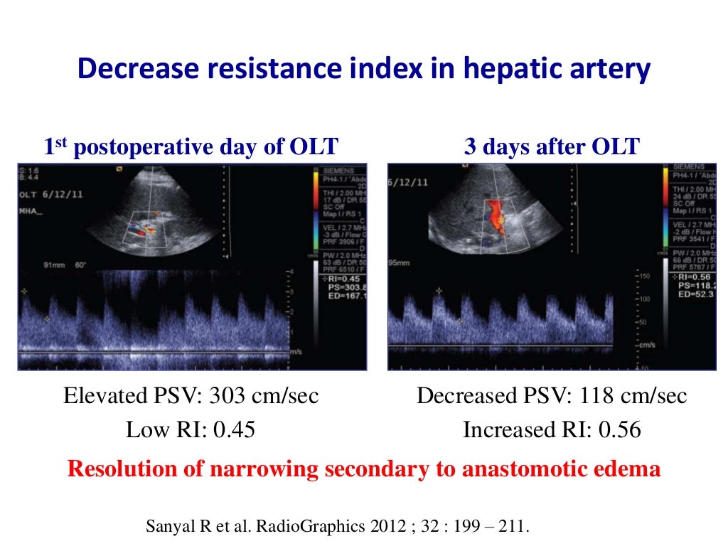 Ultrasound & doppler ultrasound in liver transplantation