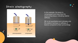 Strain elastography
In this example, the lesion is
compressed much less than the
surrounding tissue, indicating relative
stiffness.
SE is not quantitative and indicates only
the relative hardness or softness of
lesions compared to their surroundings
 