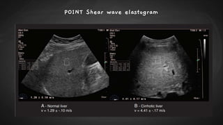 POINT Shear wave elastogram
 