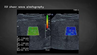 2D shear wave elastography
 