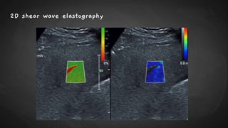 2D shear wave elastography
 