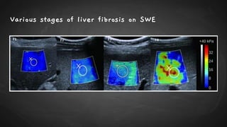 Various stages of liver fibrosis on SWE
 