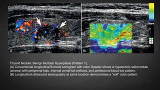 Thyroid Nodule: Benign Nodular Hyperplasia (Pattern 1).
(A) Conventional longitudinal B-mode sonogram with color Doppler shows a hypoechoic solid nodule
(arrows) with peripheral halo, internal comet-tail artifacts, and perilesional blood low pattern.
(B) Longitudinal ultrasound elastography at same location demonstrates a “soft” color pattern.
 