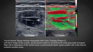 Thyroid Nodule: Benign Nodular Hyperplasia With Cystic Changes (Pattern 2).
Left half of image shows a cystic, poorly denied nodule on conventional B-mode gray-scale sonogram.
Right half of elastogram of the nodule shows a predominantly elastic (green) pattern with a few internal
anelastic bandlike areas.
 
